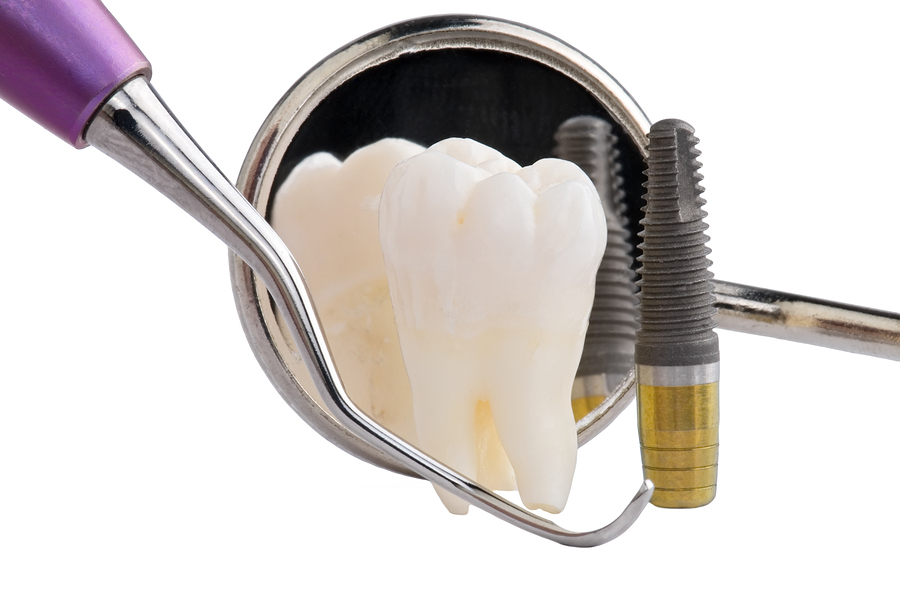 dental implants north augusta